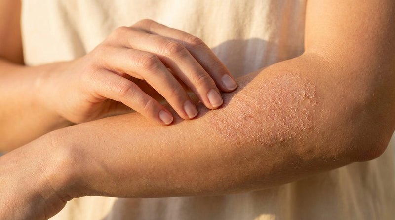 Evening Primrose Oil for Eczema: Can GLA Help Inflammatory Skin Conditions?